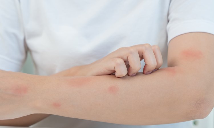Person kratzt Unterarm mit roten Stellen